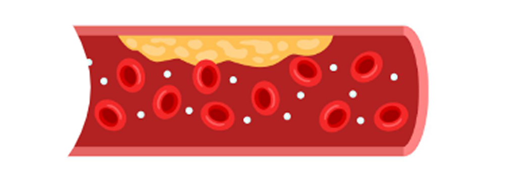 傷ついた血管にLDLコレステロールが入り込みます。