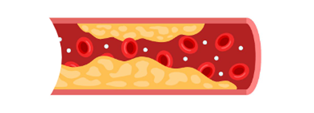 LDLコレステロールが積み重なるとプラークという塊になります。