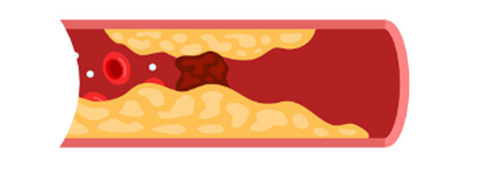 プラークが大きくなると、血液の流れが悪くなります。最悪の場合血管が詰まってしまいます。